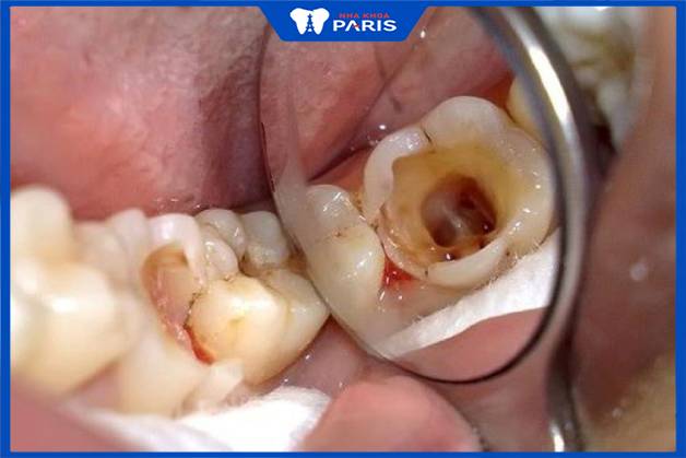 Không bọc răng sứ sau lấy tủy dễ bị sâu răng, nhiễm trùng tái phát