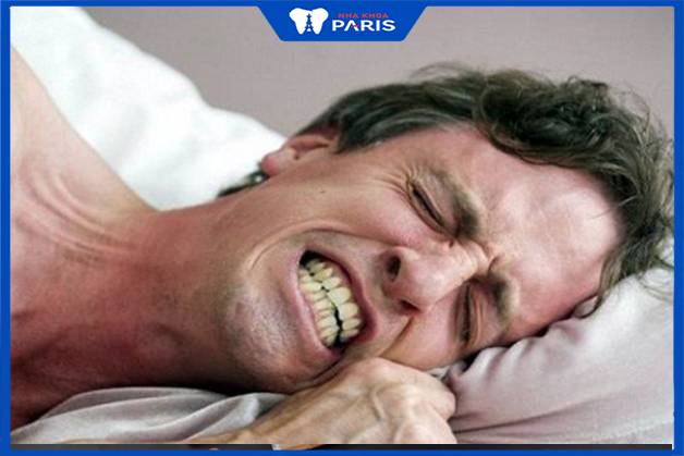Cần đeo máng chống nghiến để bảo vệ răng sứ khi ngủ