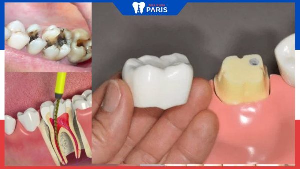 Nha sĩ chỉ ra 4 lý do nên bọc răng sứ sau khi lấy tủy