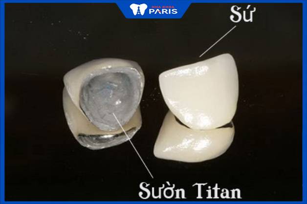 Răng sứ titan gồm 2 phần: Phần lõi titan và phần ngoài phủ sứ