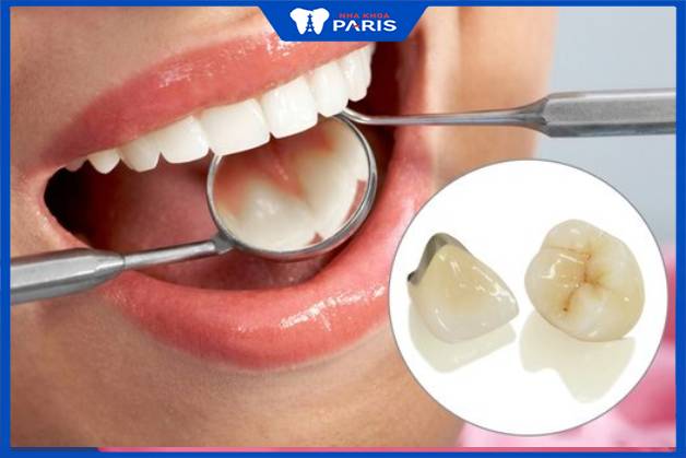 Bọc răng sứ titan được nhiều khách hàng lựa chọn do chi phí thấp