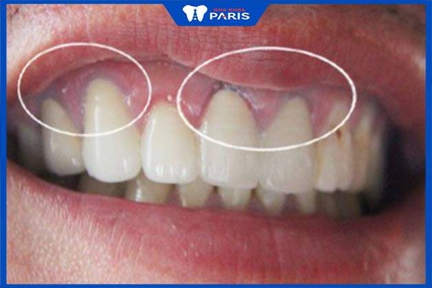 Răng sứ sau 1 thời gian sử dụng gây đen viền nướu