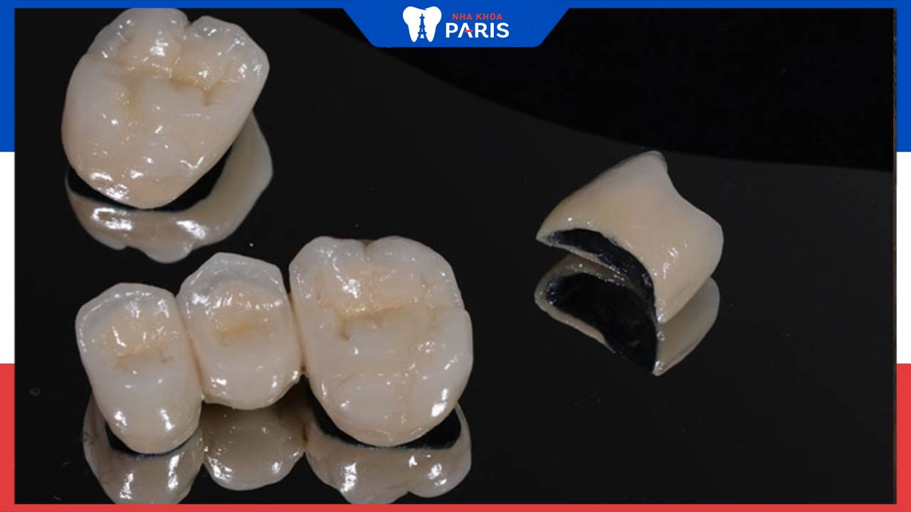 Nên bọc răng sứ titan không – Chuyên gia phân tích ưu nhược điểm chi tiết