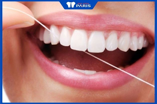 Cách vệ sinh cầu răng sứ bằng chỉ nha khoa