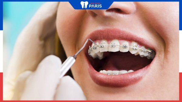 Chi phí niềng răng mắc cài kim loại bao nhiêu: các yếu tố tác động tới chi phí