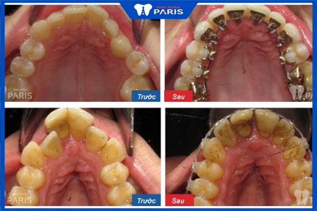 Hình ảnh khách hàng trước và sau khi niềng răng mắc cài kim loại