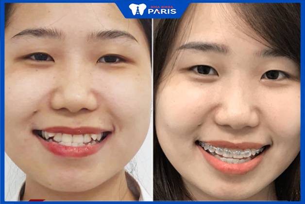 Case trước và sau khi niềng răng tại Paris