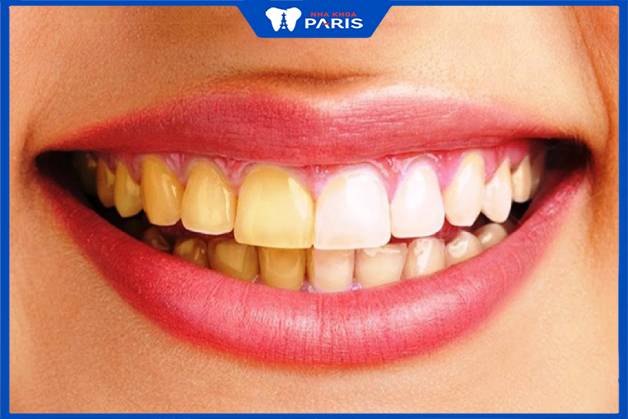 Dán răng sứ rất tốt cho người có có hàm răng bị xỉn màu, ố vàng