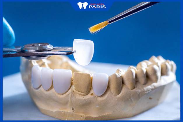 Dán răng sứ không ảnh hưởng đến tủy răng