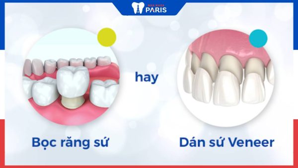 Hỏi đáp chuyên gia: Dán răng sứ và bọc răng sứ cái nào tốt hơn?