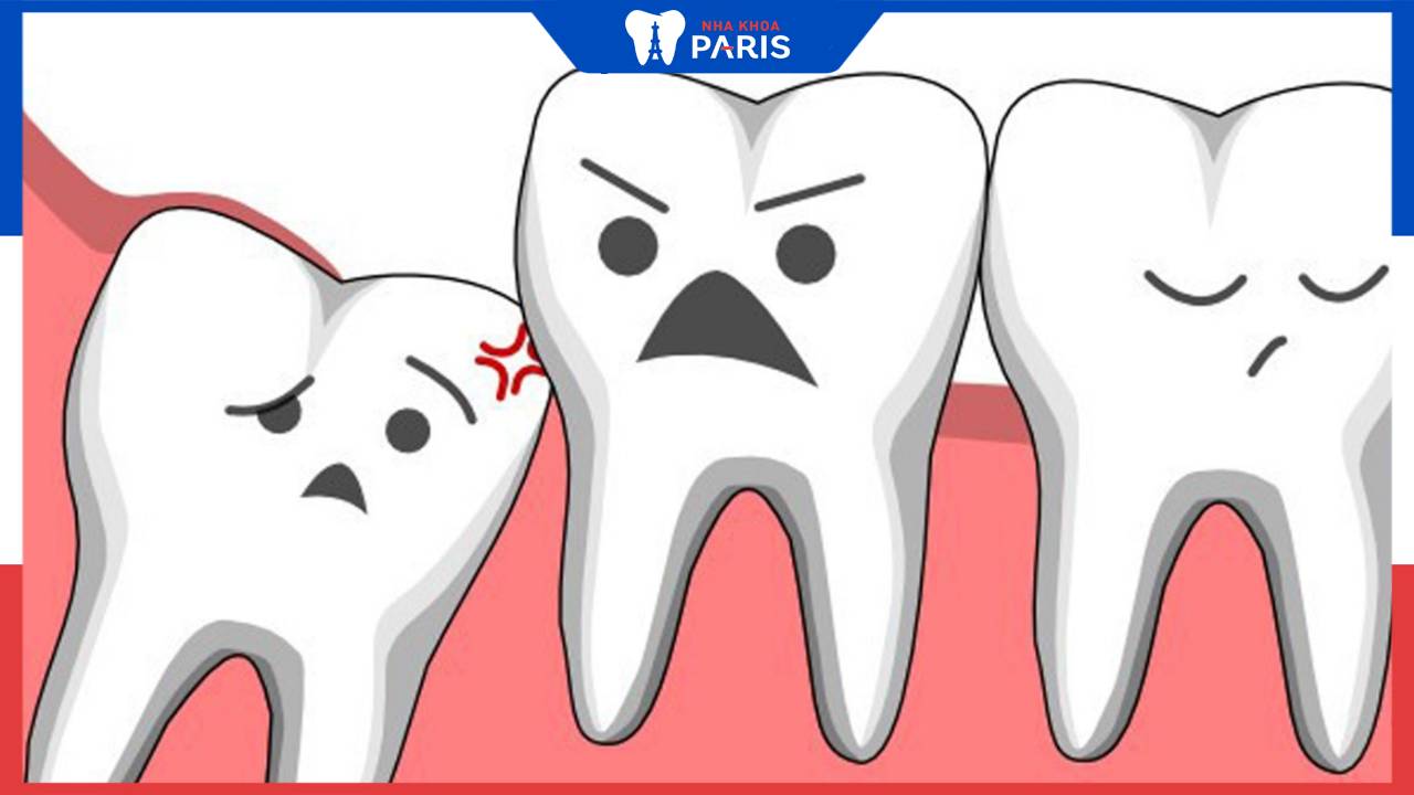 Dấu hiệu mọc răng khôn: Cách nhận biết và xử lý răng khôn đúng 