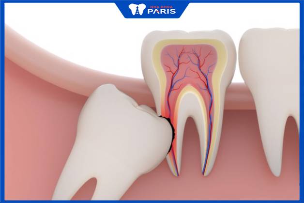 Răng khôn phải đâm thủng nướu để trồi lên trong miệng. Vì vậy, nó thường gây đau nhức dữ dội cho người bệnh. 