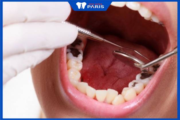Đau răng sâu kéo dài bao lâu tùy thuộc vào mức độ sâu