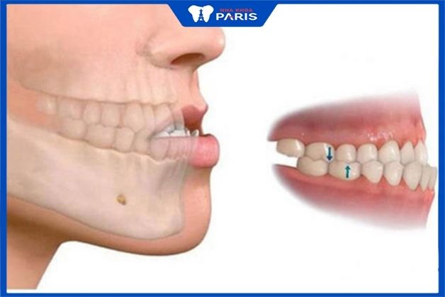 Khớp cắn ngược là tình trạng răng hàm dưới bao phủ răng hàm trên - khớp cắn ngược là gì
