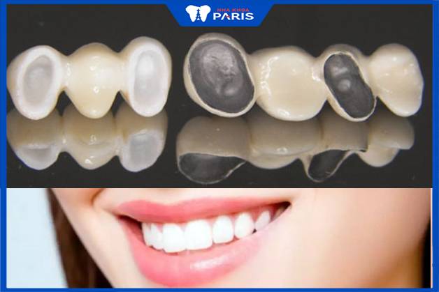 Có 2 loại răng sứ chính là răng sứ kim loại và răng sứ toàn sứ