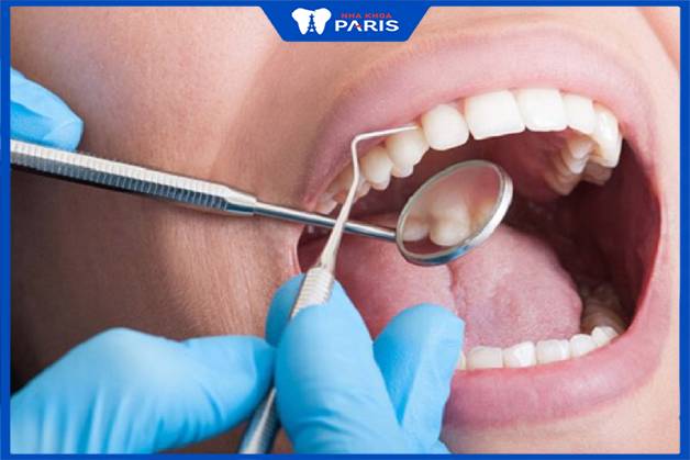 Lấy vôi răng giúp răng trắng đẹp, phòng ngừa các bệnh lý nha khoa