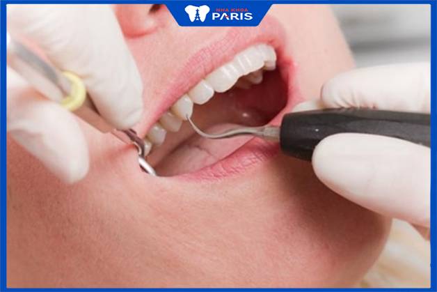 Lấy cao răng không đau nếu được thực hiện đúng kỹ thuật dưới sự hỗ trợ của máy siêu âm