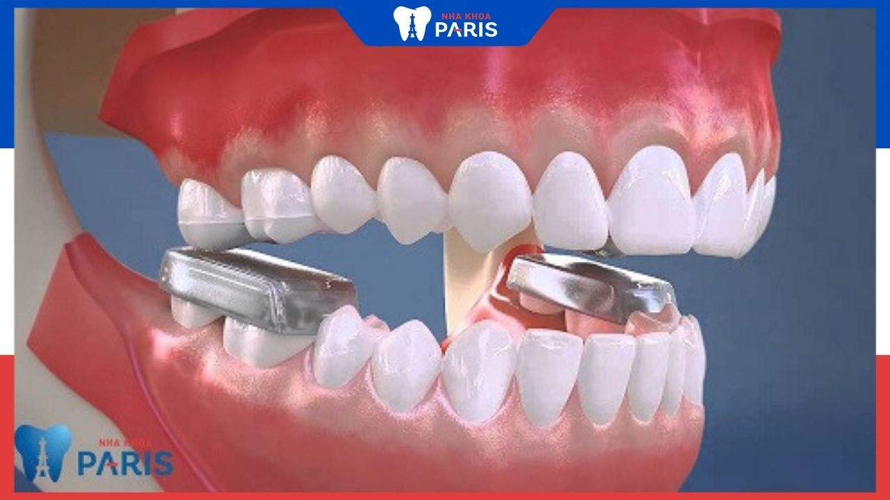 6 thông tin quan trọng về nâng khớp cắn trong niềng răng