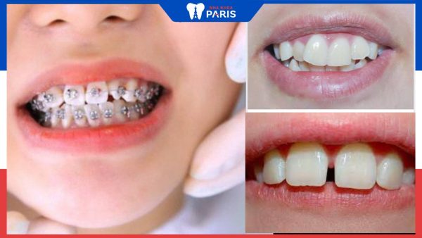 Niềng 2 răng cửa bị lệch: Phương pháp và giá cả niềng răng