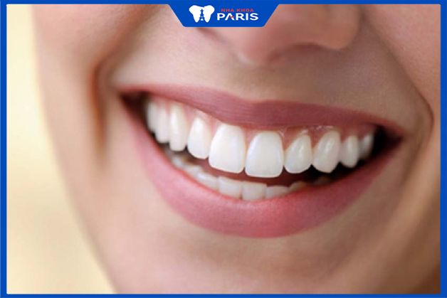 Niêng răng bao nhiêu là thắc mắc của nhiều bệnh nhân khi có nhu cầu thẩm mỹ nha khoa
