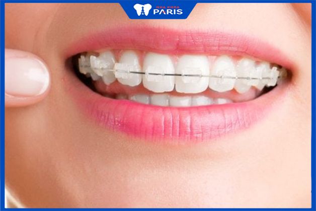 NIềng răng mắc cài sứ có nguyên lý hoạt động tương tự niềng răng mắc cài kim loại