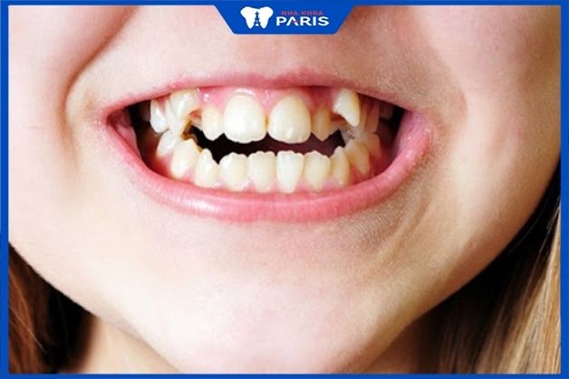 Chỉnh nha sớm giúp ngăn chặn các bệnh về răng miệng
