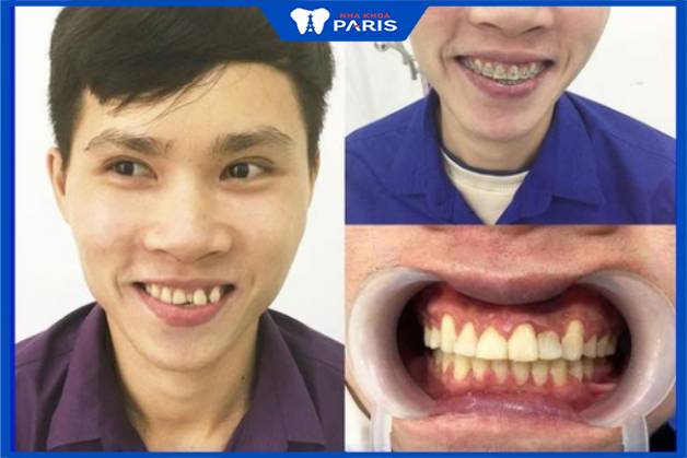 KH Nguyễn Văn Quý sở hữu hàm răng đều đẹp sau 12 tháng đeo niềng kim loại