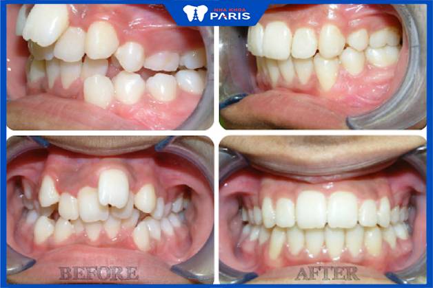 Kết quả trước và sau khi niềng răng khấp khểnh tại nha khoa Paris