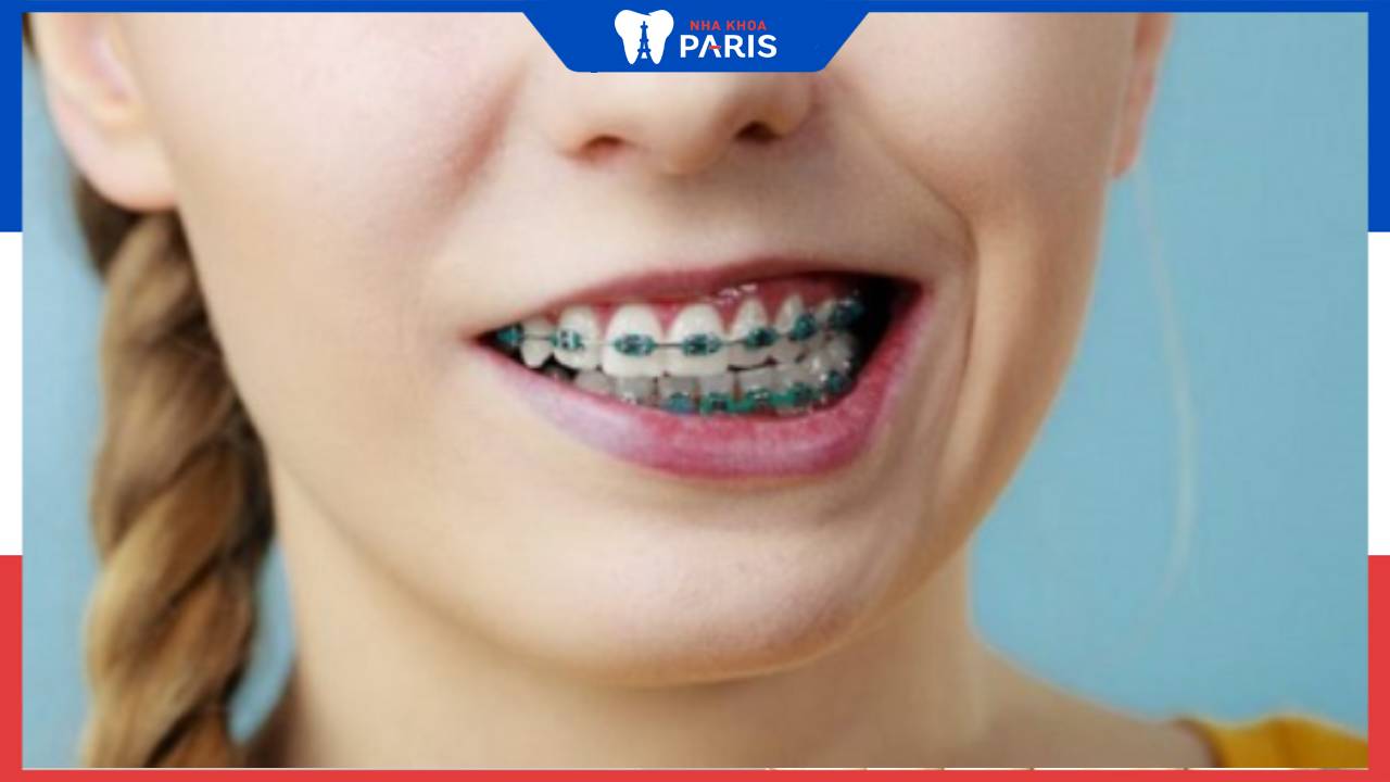Hỏi đáp: Niềng răng lệch cằm có làm hết cằm lệch không? 