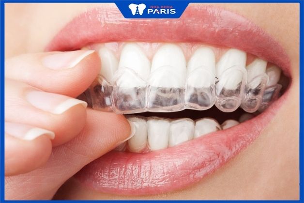 Chỉnh nha răng hô tại Nha khoa Paris đem đến nụ cười tỏa nắng