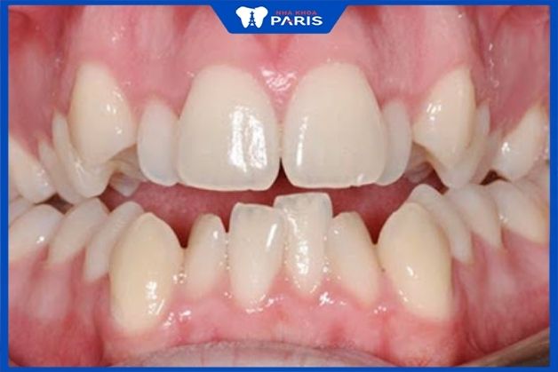 Niềng răng khi răng có nhiều khuyết điểm