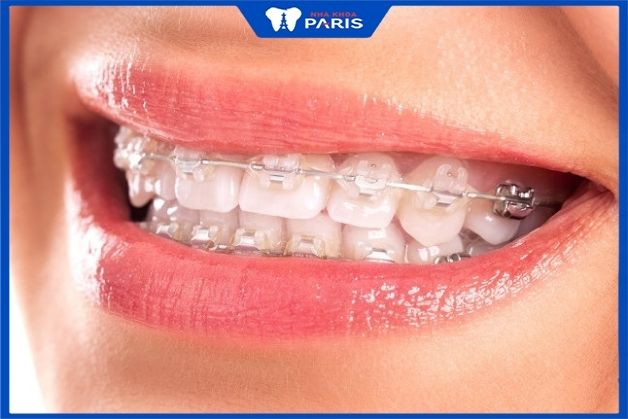 Chỉnh nha bằng mắc cài sứ mất bao lâu có hàm răng đẹp?