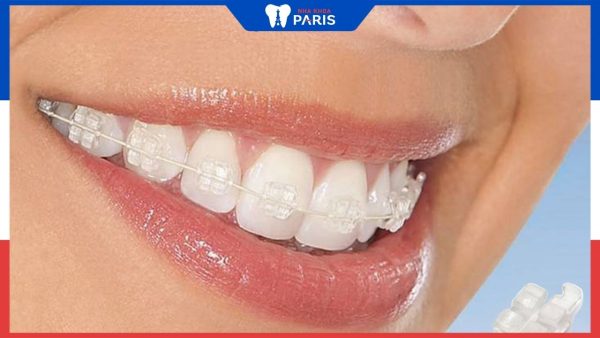 Niềng răng mắc cài sứ mất bao lâu? Thời gian cụ thể từng giai đoạn