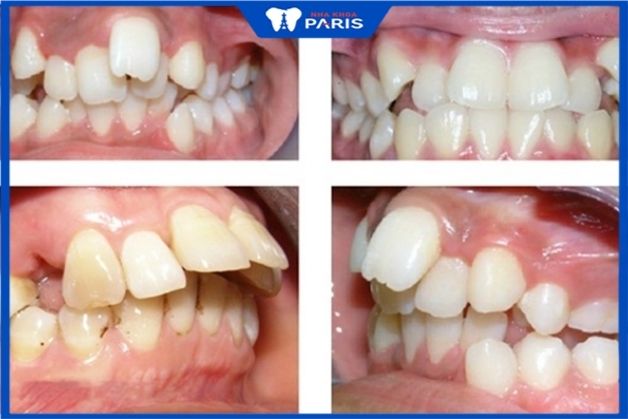 Những khuyết điểm về răng thường gặp