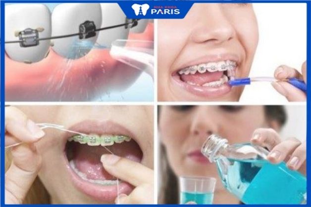 Chăm sóc răng miệng sau niềng răng