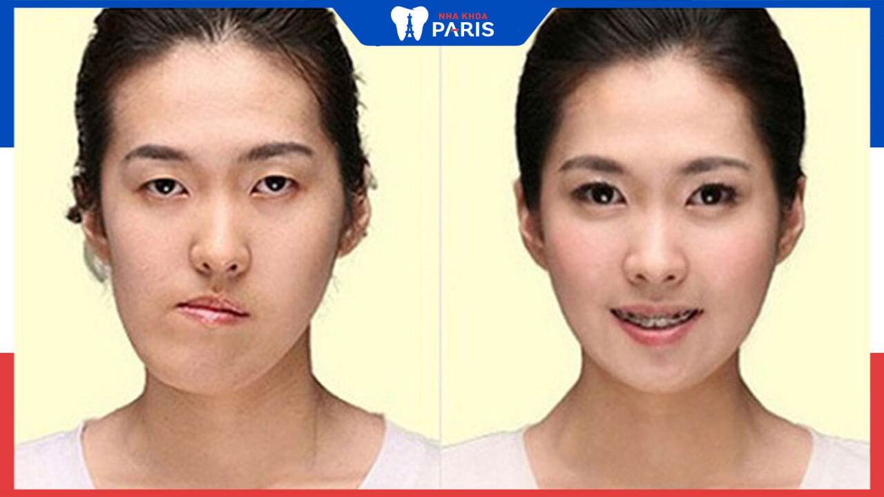 Niềng răng mặt lệch: Nguyên nhân, cách khắc phục và chi phí