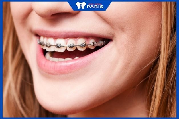 Lựa chọn nha khoa uy tín đảm bảo sức khỏe răng miệng và đạt hiệu quả chỉnh nha cao