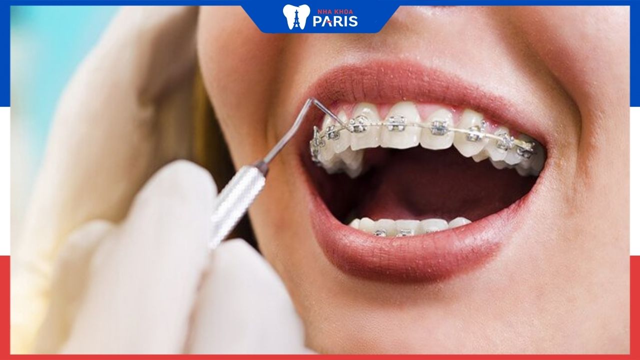 Hỏi đáp: Niềng răng xong răng có yếu đi không