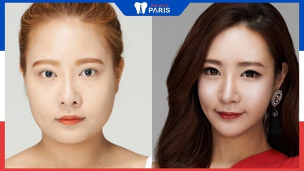 Phẫu thuật mặt thon gọn – Giải pháp số 1 giúp góc mặt đẹp trọn đời