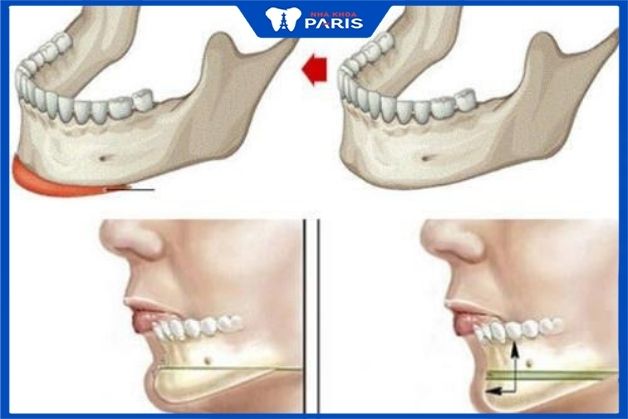 Tìm hiểu về phẫu thuật trượt hàm 