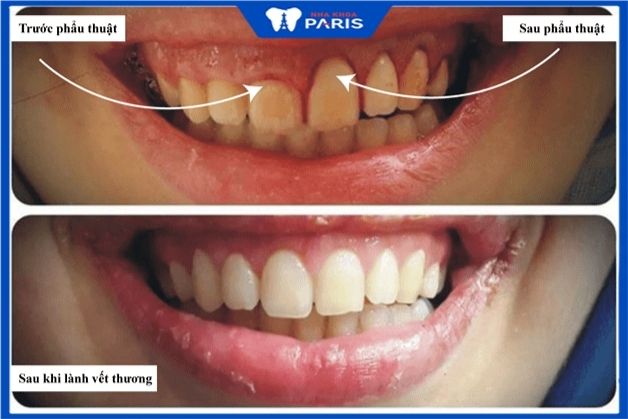 Trước và sau phẫu thuật răng ngắn cười hở lợi