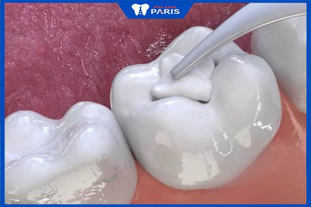 Trám răng khắc phục nứt vỡ mức độ nhẹ