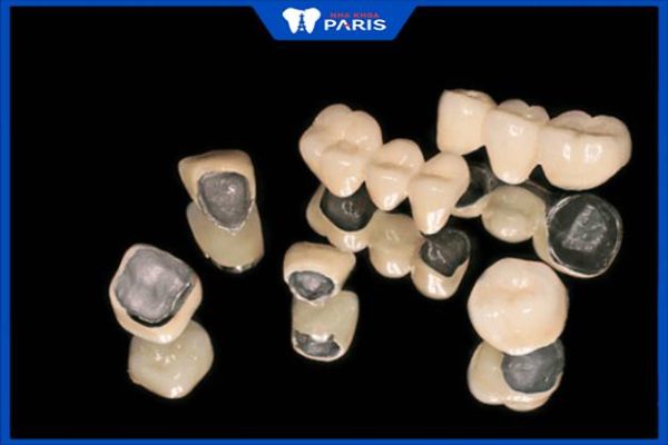 Góc giải đáp: Răng sứ kim loại có bền không? Tuổi thọ bao nhiêu năm? 