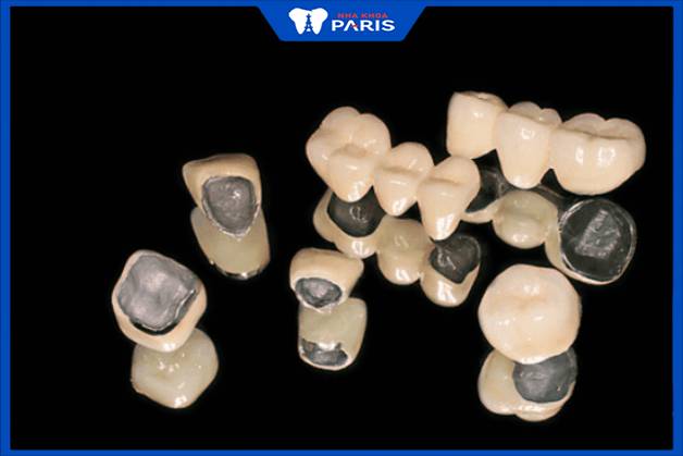 Răng sứ kim loại có bền không được nhiều người quan tâm