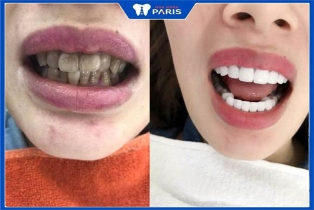 Khách hàng trước và sau khi bọc răng sứ kim loại