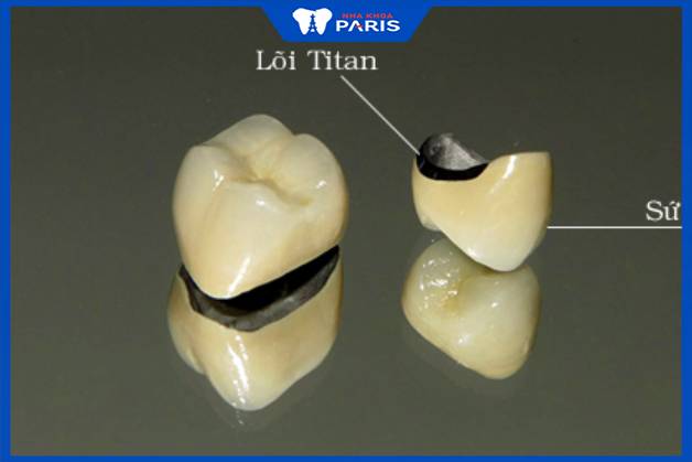 Răng sứ kim loại titan là gì