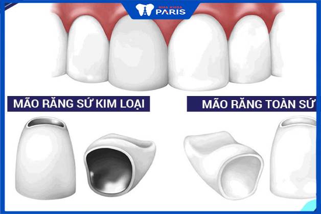 Răng sứ và răng kim loại đều là răng giả sử dụng phổ biến trong phục hình nha khoa