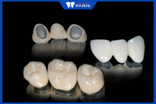 Răng kim loại có tính thẩm mỹ kém hơn răng toàn sứ