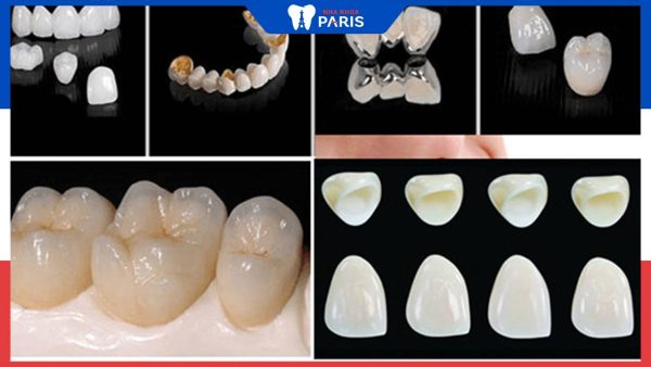Răng sứ và răng kim loại: So sánh ưu nhược điểm, loại nào tốt hơn? 