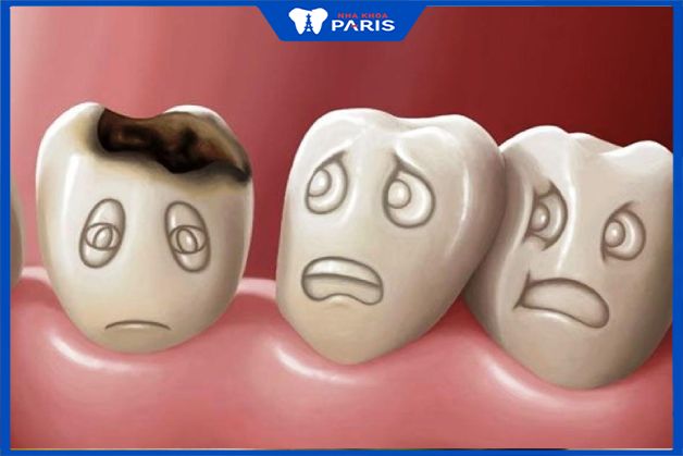 Vi khuẩn phân hủy thức ăn tạo ra acid ăn mòn men răng, khiến răng bị hư hỏng